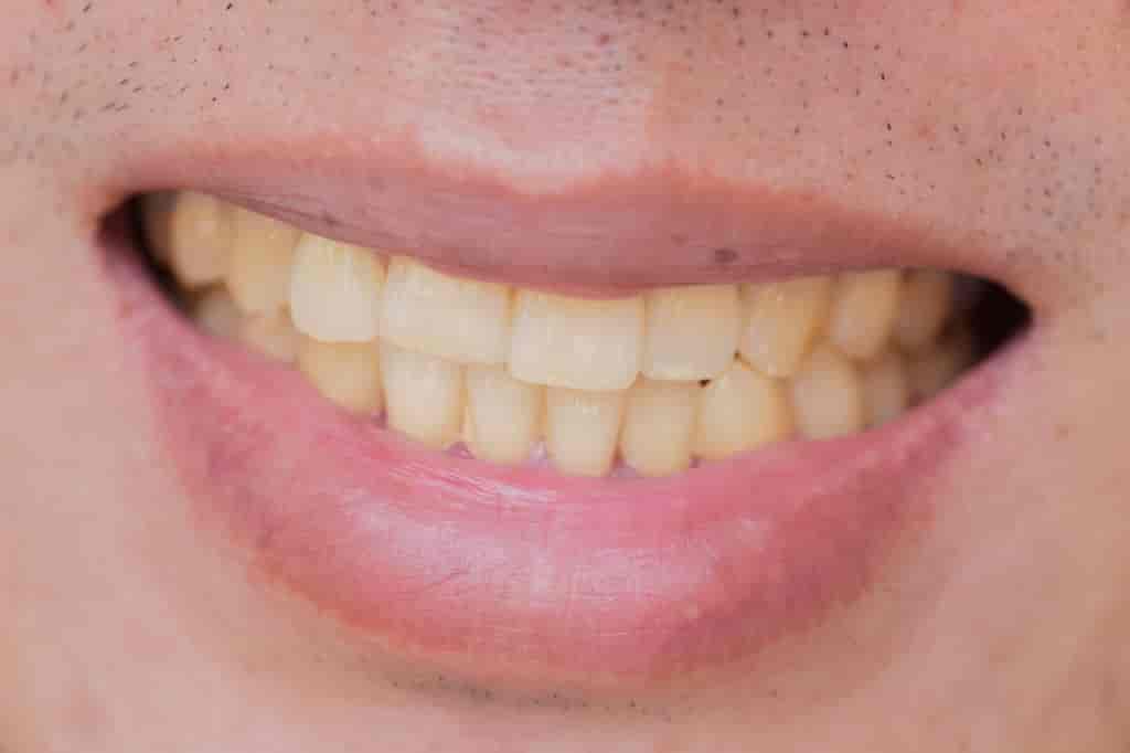 really yellow teeth teeth whitening damage enamel natural yellow teeth